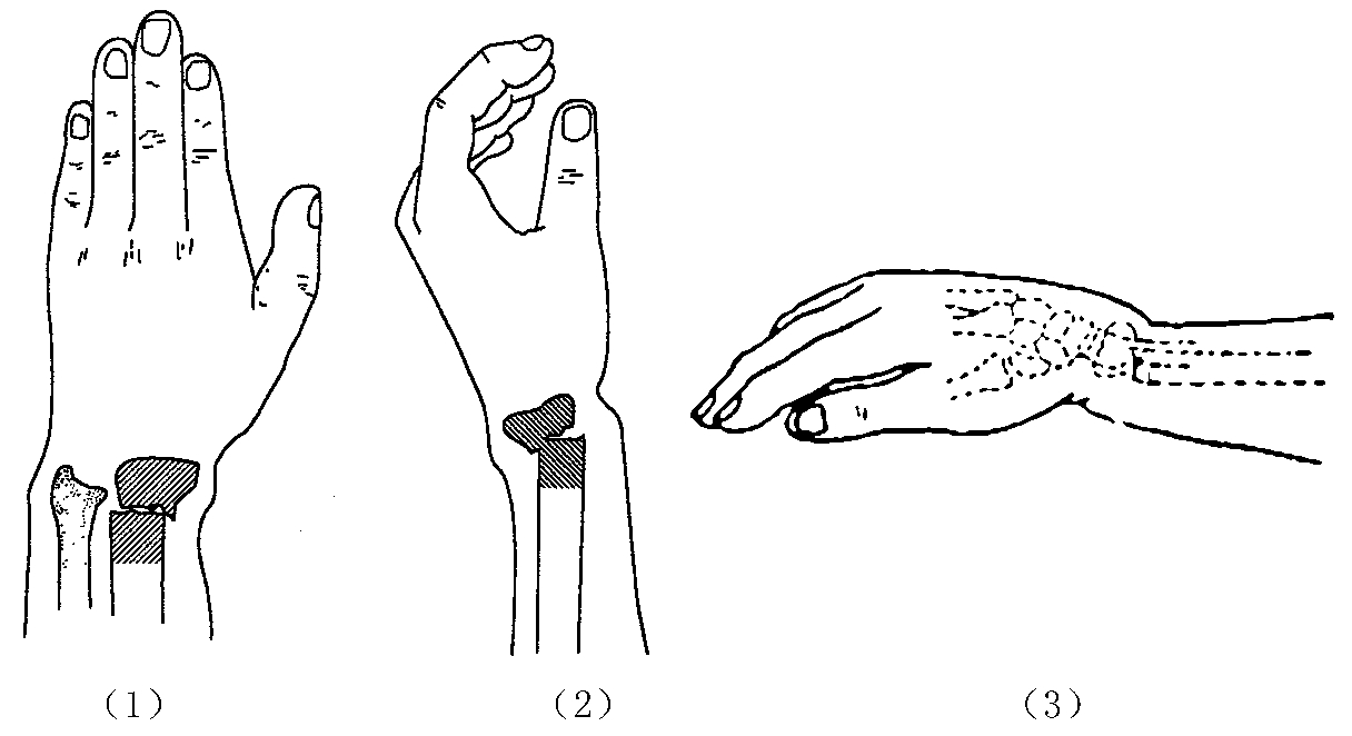 超声骨密度仪临床研究发生桡骨远端骨折怎么办？