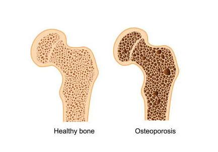 50岁骨密度正常值在这个范围吃这些东西能够增加骨密度