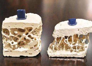 骨密度仪提示骨质疏松并非是老年人的“专利”五宜五忌不要掉以轻心