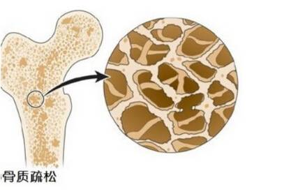 骨密度检测仪阐述多吃醋会让骨钙溶出而流失造成骨质疏松