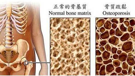 骨密度检测仪建议最好到有专业仪器的大医院进行正规的骨密度测定