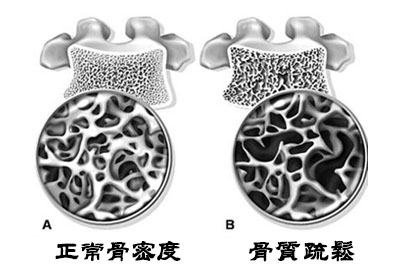 超声骨密度仪生产厂家介绍我们如何在有效健身运动时提高骨密度？