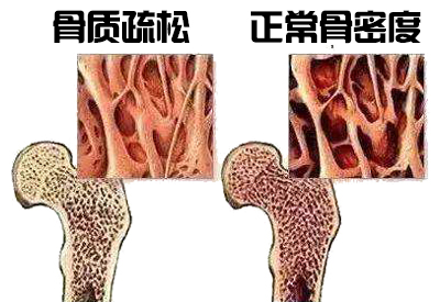 骨密度仪生产厂家介绍其实各个年龄阶段骨密度不同最佳检测年是多少你知道吗？