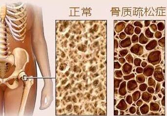 骨密度测试是通过骨密度检测仪器测试你是否患有骨质疏松症