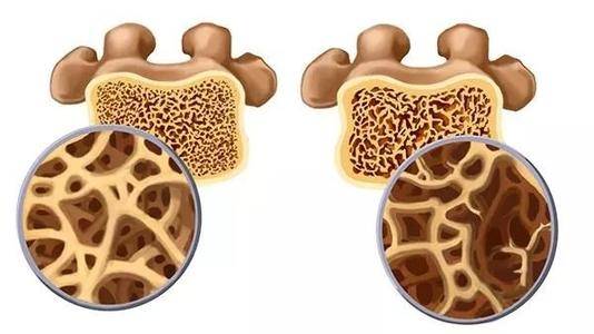 超声骨密度测定仪让大家更好的了解骨骼情况该如何预防骨质疏松?
