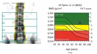 超声骨密度分析仪品牌检测数据怎么看详情？测量结果怎么看